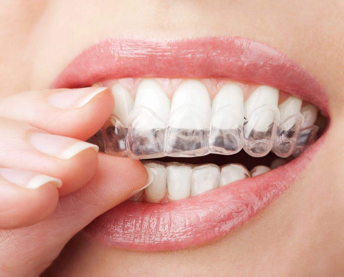 Comment choisir son praticien Invisalign ?