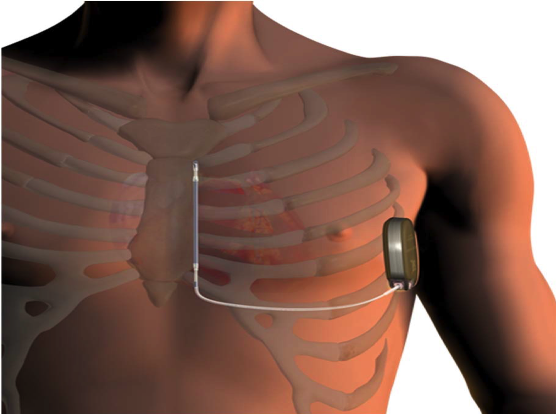 Qu’est-ce qu’un défibrillateur pour le cœur ?